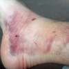 steves_foot_20100319_1775467780